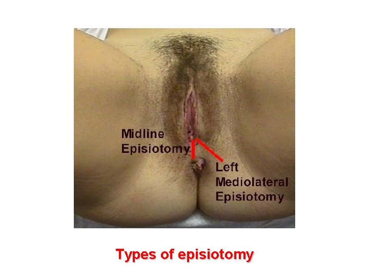 Types of episiotomy 