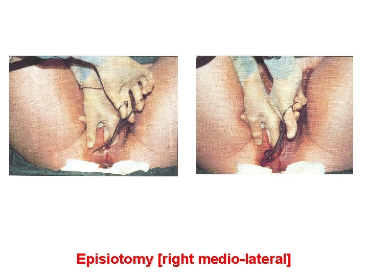 Episiotomy [right medio-lateral] 