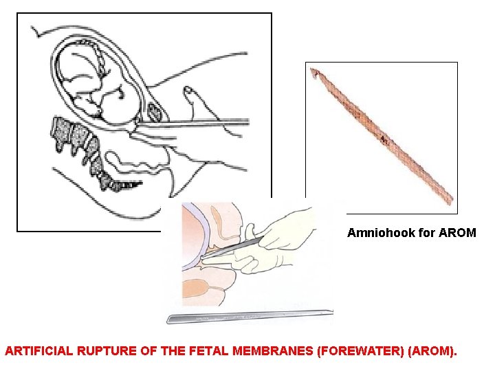 Amniohook for AROM ARTIFICIAL RUPTURE OF THE FETAL MEMBRANES (FOREWATER) (AROM). 