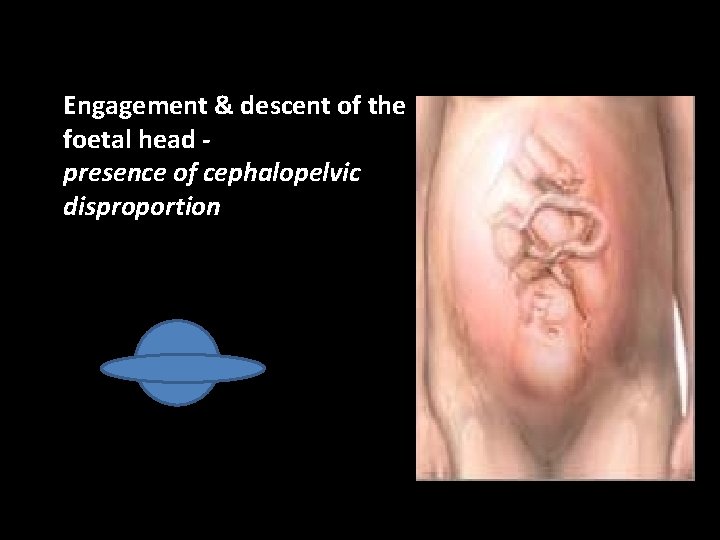 Engagement & descent of the foetal head presence of cephalopelvic disproportion 