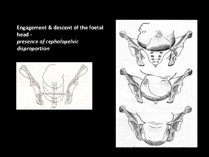 Engagement & descent of the foetal head presence of cephalopelvic disproportion 
