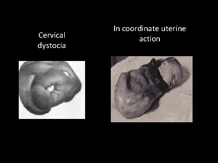 Cervical dystocia In coordinate uterine action 