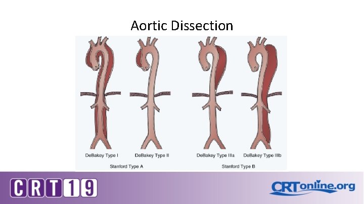 Aortic Dissection 
