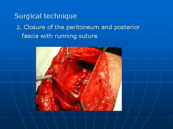 Surgical technique 2. Closure of the peritoneum and posterior fascia with running suture 