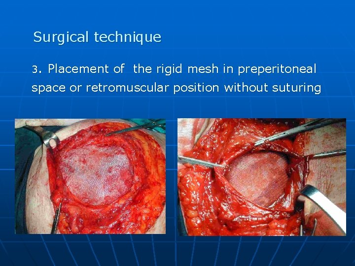 Surgical technique 3. Placement of the rigid mesh in preperitoneal space or retromuscular position