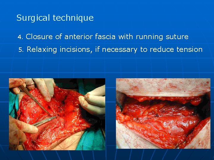 Surgical technique 4. Closure of anterior fascia with running suture 5. Relaxing incisions, if