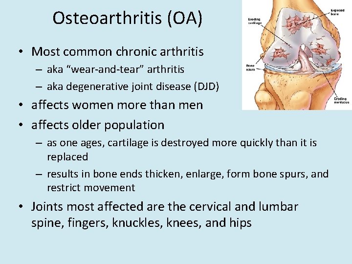 Osteoarthritis (OA) • Most common chronic arthritis – aka “wear-and-tear” arthritis – aka degenerative