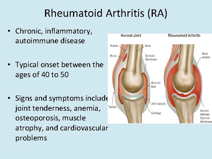 Rheumatoid Arthritis (RA) • Chronic, inflammatory, autoimmune disease • Typical onset between the ages