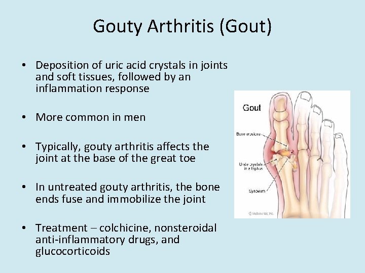 Gouty Arthritis (Gout) • Deposition of uric acid crystals in joints and soft tissues,