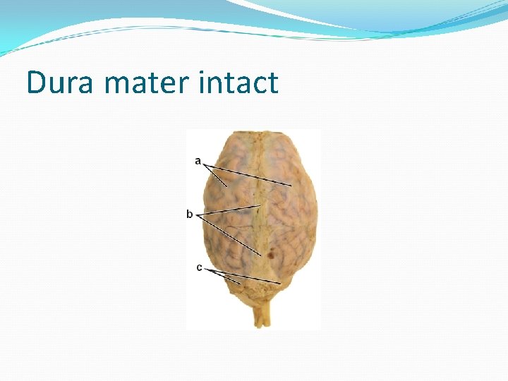 Dura mater intact 