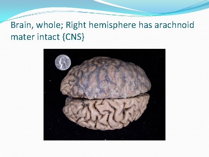 Brain, whole; Right hemisphere has arachnoid mater intact {CNS} 