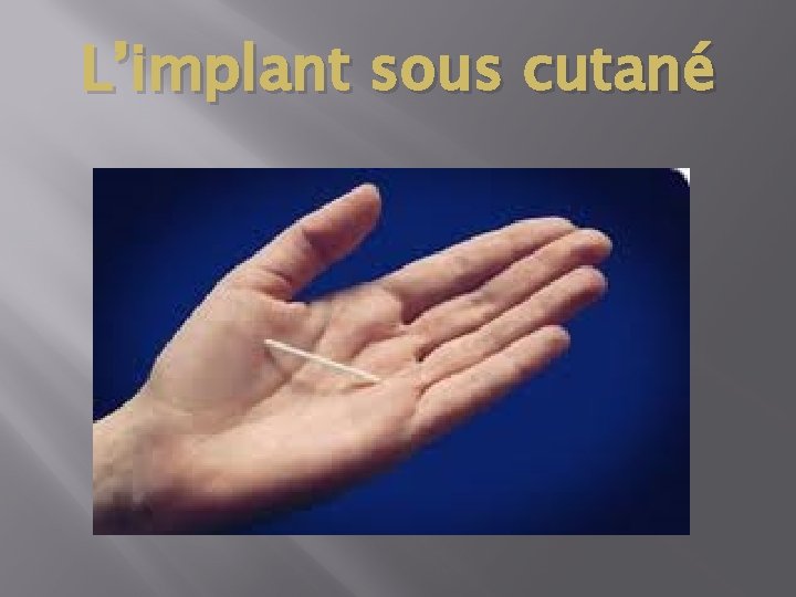 L’implant sous cutané 