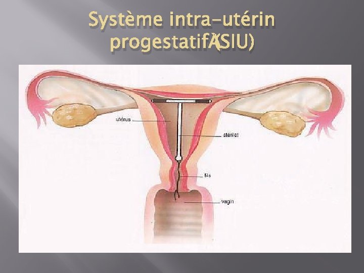 Système intra-utérin progestatif (SIU) 