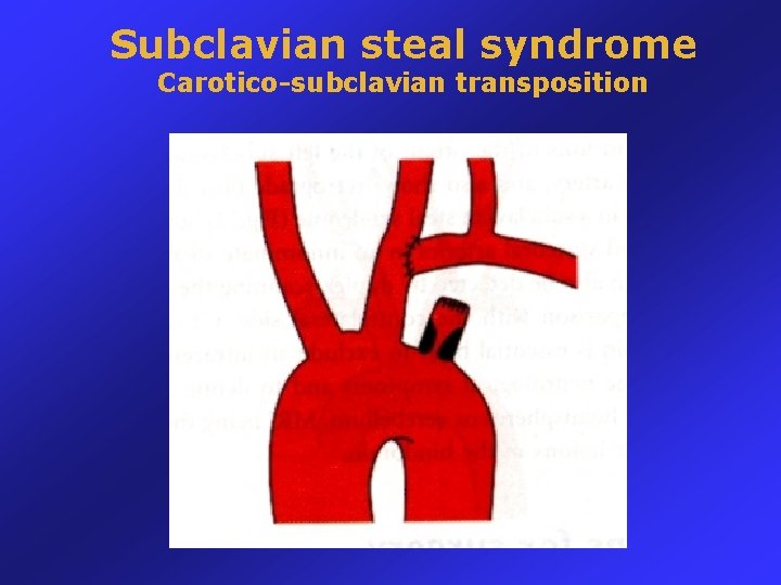 Subclavian steal syndrome Carotico-subclavian transposition 