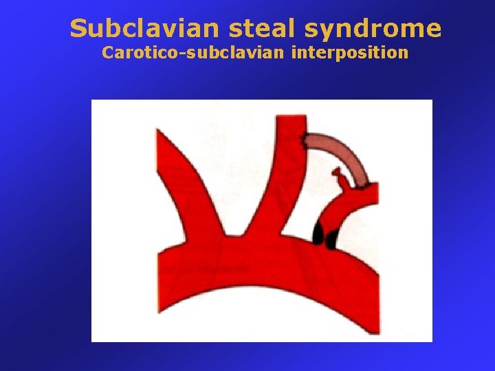 Subclavian steal syndrome Carotico-subclavian interposition 
