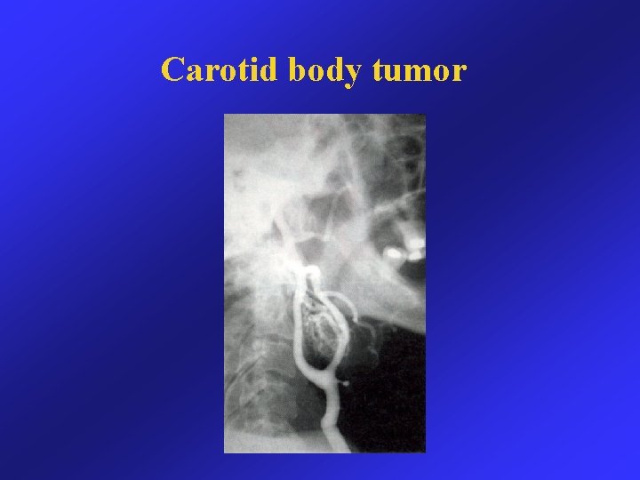 Carotid body tumor 