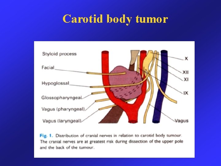 Carotid body tumor 