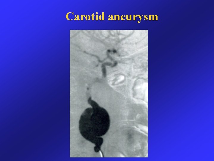 Carotid aneurysm 
