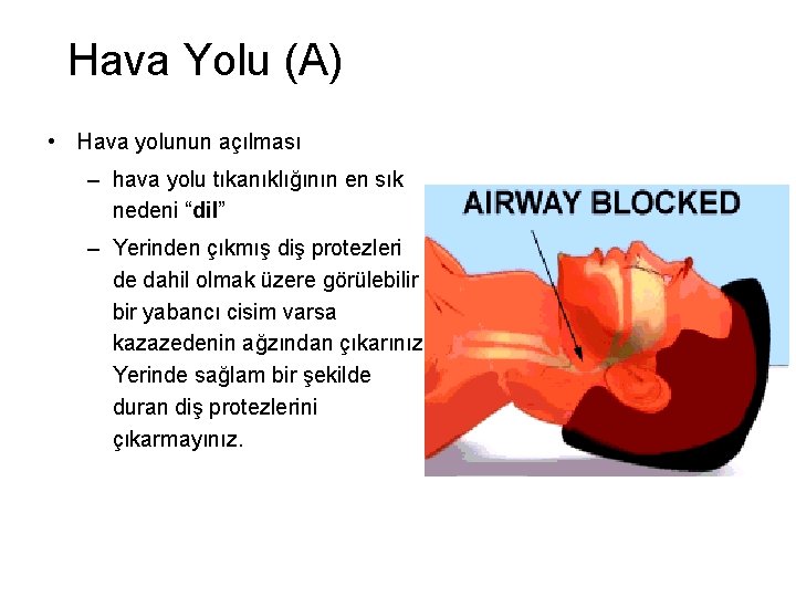 Hava Yolu (A) • Hava yolunun açılması – hava yolu tıkanıklığının en sık nedeni