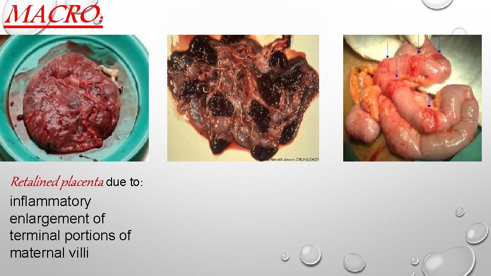 MACRO: Retalined placenta due to: inflammatory enlargement of terminal portions of maternal villi 