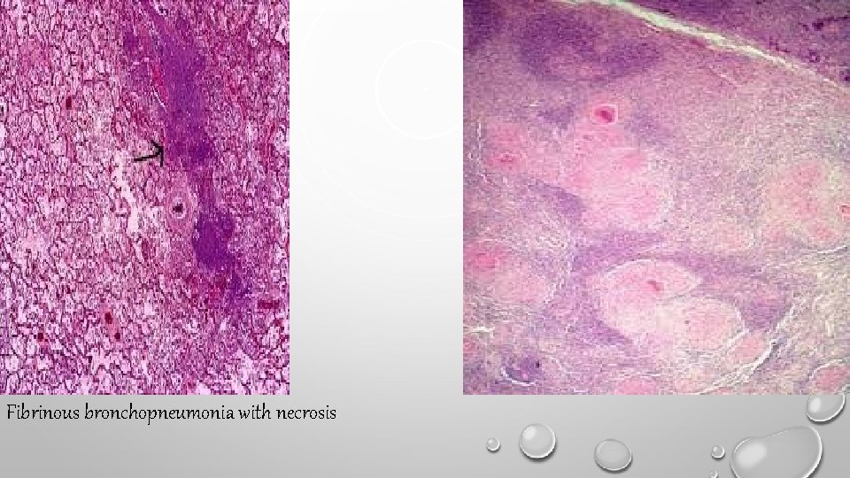 Fibrinous bronchopneumonia with necrosis 