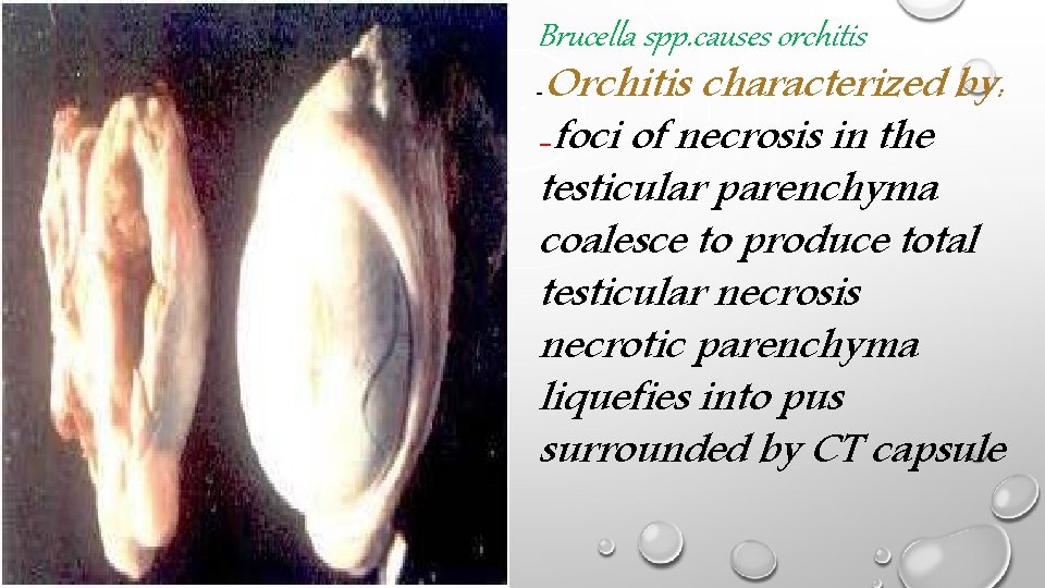 Brucella spp. causes orchitis Orchitis characterized by: -foci of necrosis in the testicular parenchyma