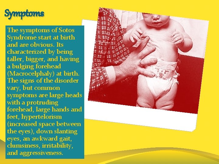 Symptoms The symptoms of Sotos Syndrome start at birth and are obvious. Its characterized