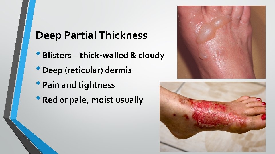 Deep Partial Thickness • Blisters – thick-walled & cloudy • Deep (reticular) dermis •