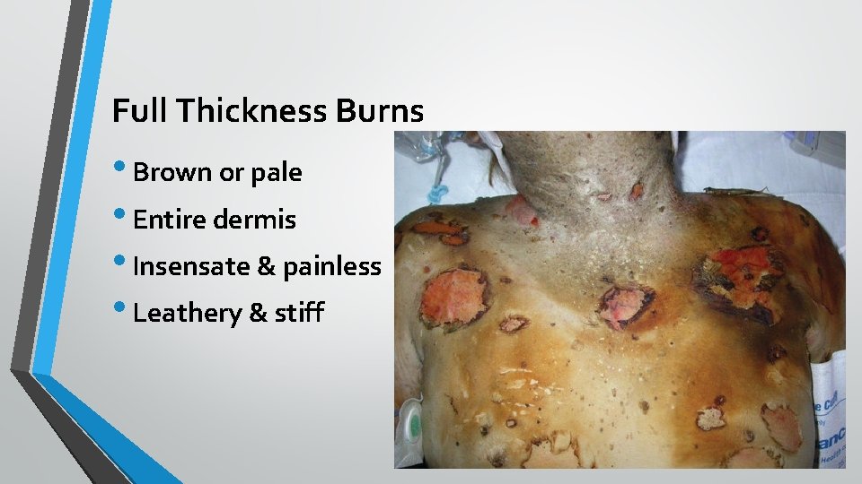 Full Thickness Burns • Brown or pale • Entire dermis • Insensate & painless