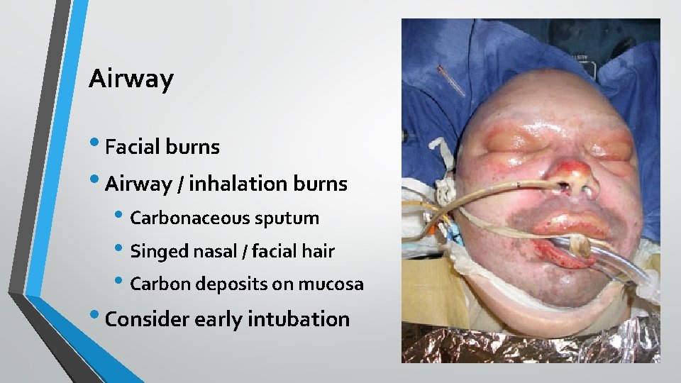 Airway • Facial burns • Airway / inhalation burns • Carbonaceous sputum • Singed