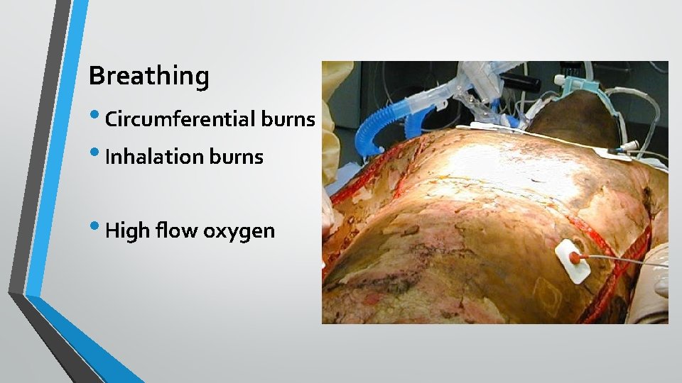 Breathing • Circumferential burns • Inhalation burns • High flow oxygen 
