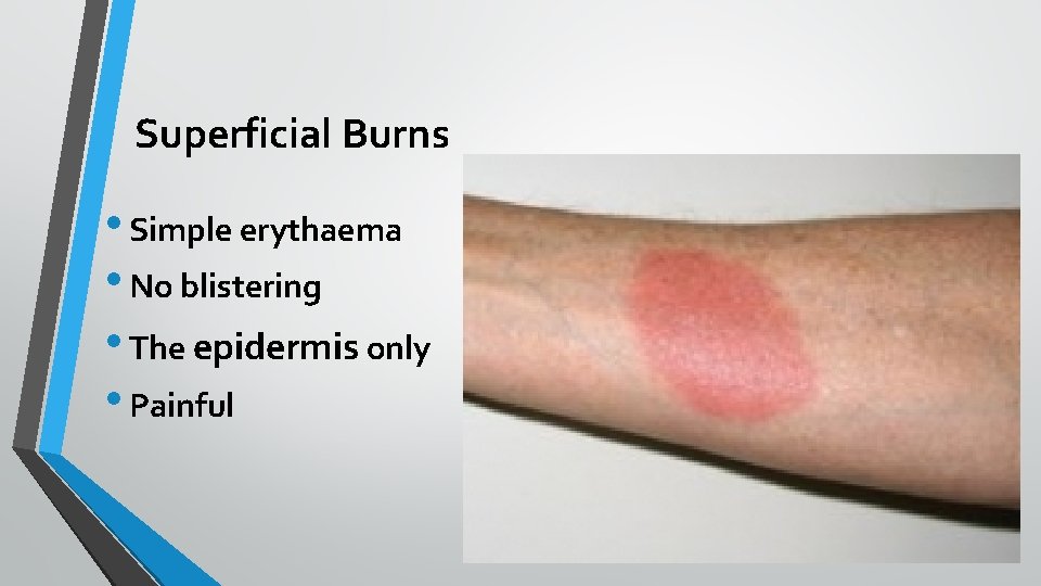 Superficial Burns • Simple erythaema • No blistering • The epidermis only • Painful