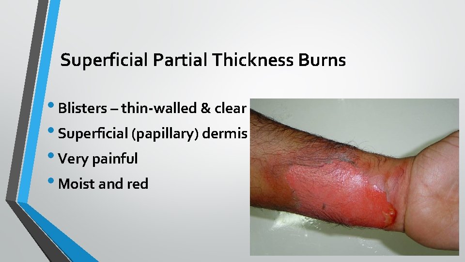 Superficial Partial Thickness Burns • Blisters – thin-walled & clear • Superficial (papillary) dermis