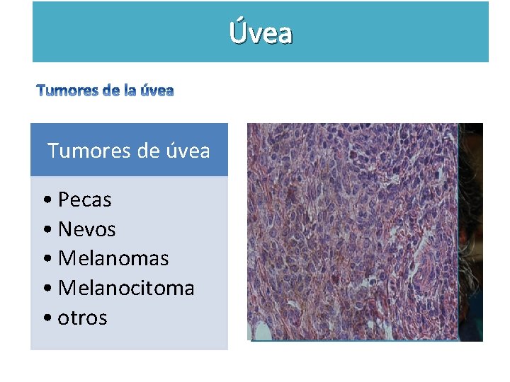 Úvea Tumores de úvea • Pecas • Nevos • Melanomas • Melanocitoma • otros