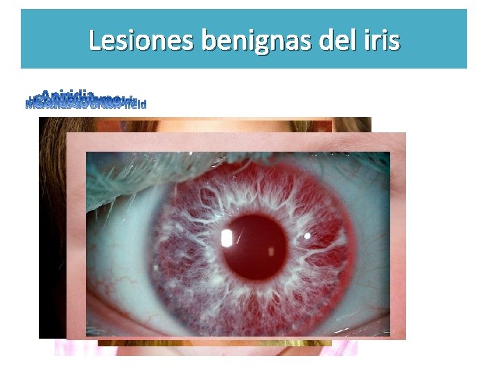 Lesiones benignas Úvea del iris 