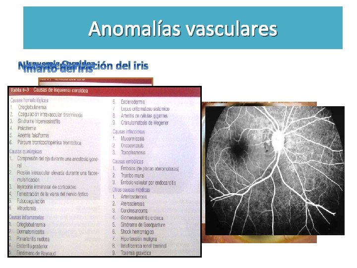 Anomalías vasculares Úvea Infarto del iris • Manifestaciones oculares: • 1. Atrofia del iris
