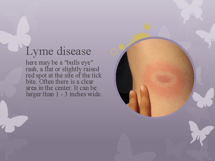 Lyme disease here may be a "bulls eye" rash, a flat or slightly raised