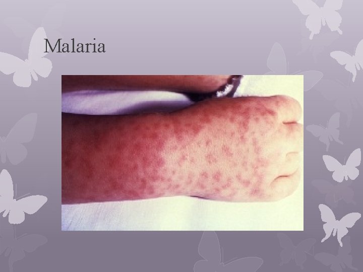Malaria 