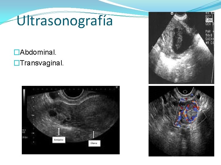 Ultrasonografía �Abdominal. �Transvaginal. 