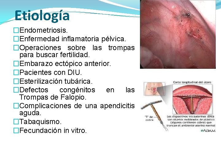 Etiología �Endometriosis. �Enfermedad inflamatoria pélvica. �Operaciones sobre las trompas para buscar fertilidad. �Embarazo ectópico