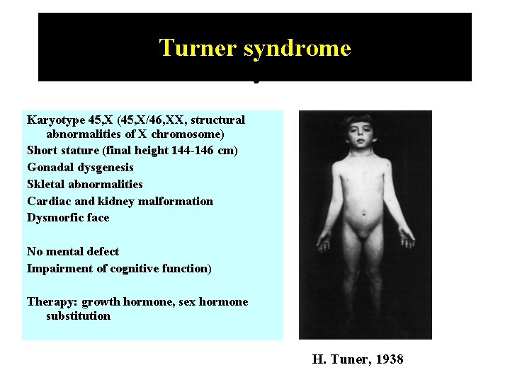 Turner syndrome Karyotype 45, X (45, X/46, XX, structural abnormalities of X chromosome) Short
