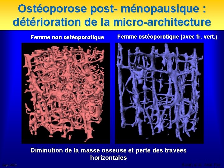 Ostéoporose post- ménopausique : détérioration de la micro-architecture Femme non ostéoporotique Femme ostéoporotique (avec