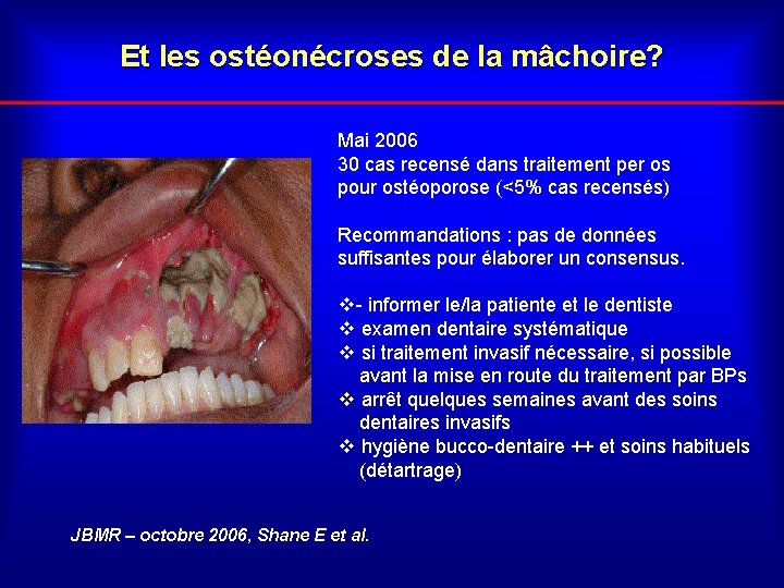 Et les ostéonécroses de la mâchoire? Mai 2006 30 cas recensé dans traitement per