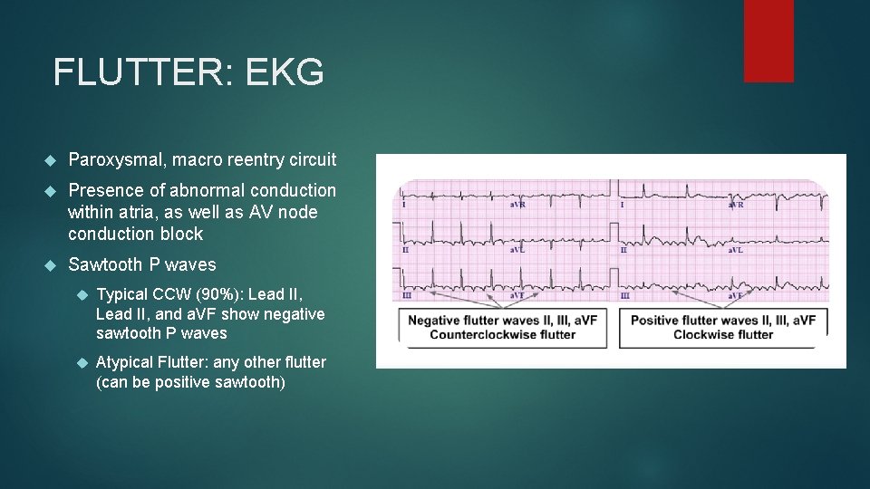 FLUTTER: EKG Paroxysmal, macro reentry circuit Presence of abnormal conduction within atria, as well FLUTTER: EKG Paroxysmal, macro reentry circuit Presence of abnormal conduction within atria, as well