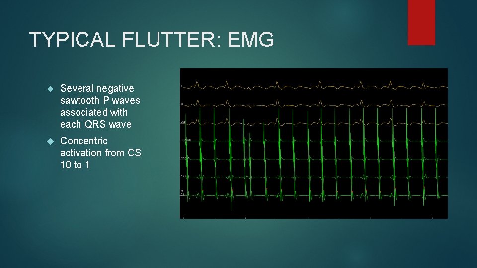 TYPICAL FLUTTER: EMG Several negative sawtooth P waves associated with each QRS wave Concentric TYPICAL FLUTTER: EMG Several negative sawtooth P waves associated with each QRS wave Concentric