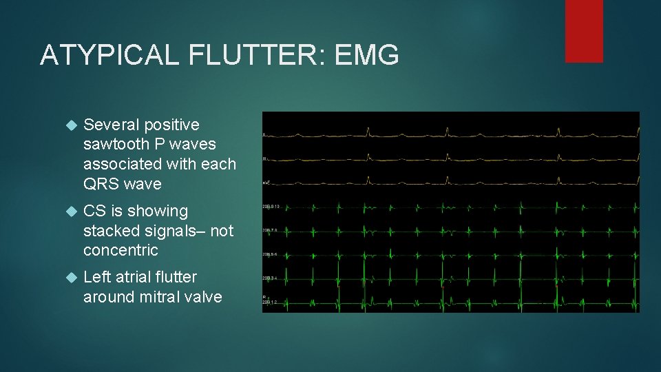 ATYPICAL FLUTTER: EMG Several positive sawtooth P waves associated with each QRS wave CS ATYPICAL FLUTTER: EMG Several positive sawtooth P waves associated with each QRS wave CS
