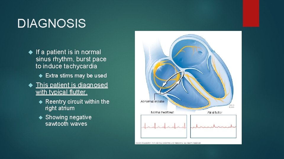 DIAGNOSIS If a patient is in normal sinus rhythm, burst pace to induce tachycardia DIAGNOSIS If a patient is in normal sinus rhythm, burst pace to induce tachycardia