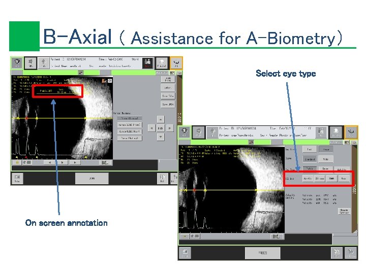 B-Axial ( Assistance for A-Biometry） Select eye type On screen annotation 