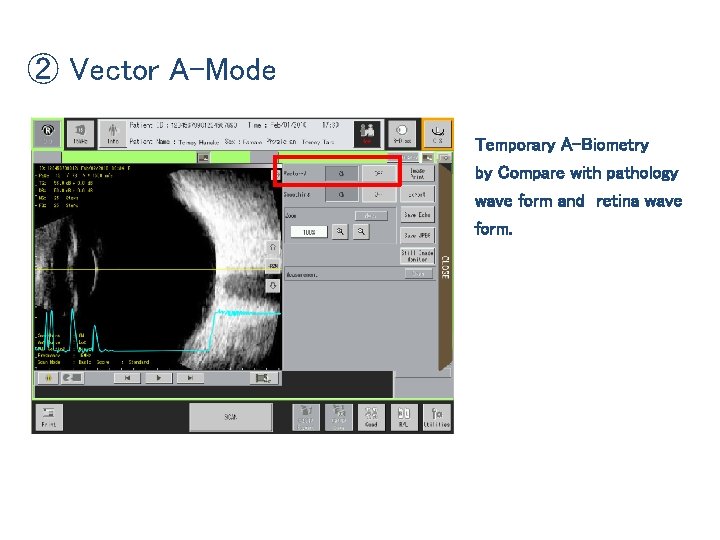 ② Vector A-Mode Temporary A-Biometry by Compare with pathology wave form and retina wave