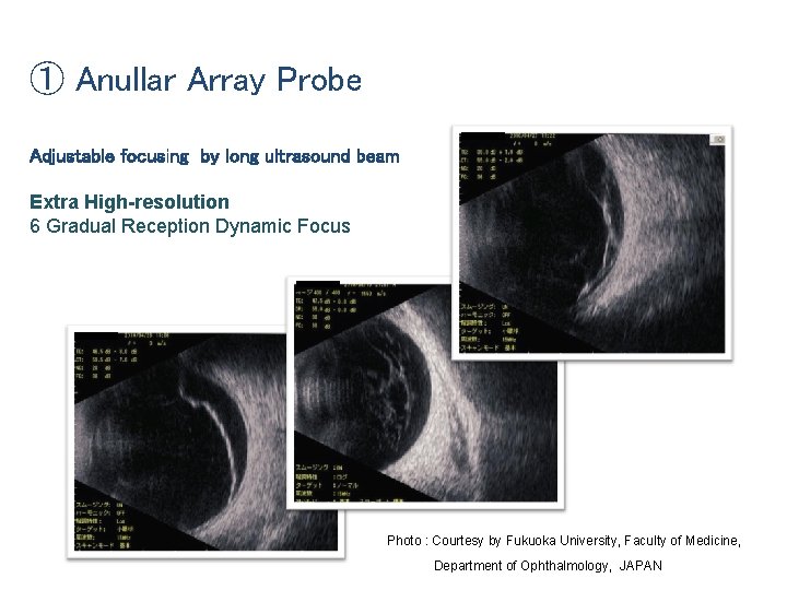 ① Anullar Array Probe Adjustable focusing by long ultrasound beam Extra High-resolution 6 Gradual